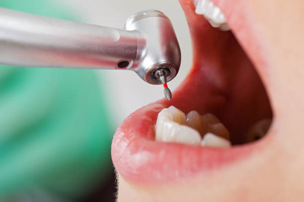 Best Emergency Dentist for Lost Fillings or Crowns in USA
